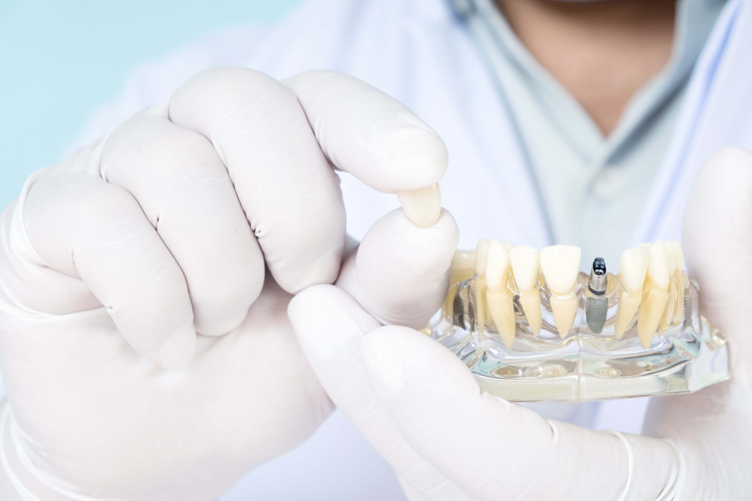 Everything You Need to Know About Dental Implants Implants Northwest